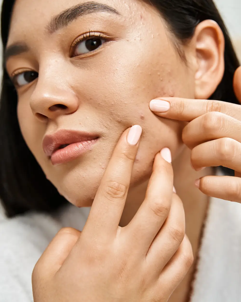 Ακμή - Θεραπεία και Αντιμετώπιση