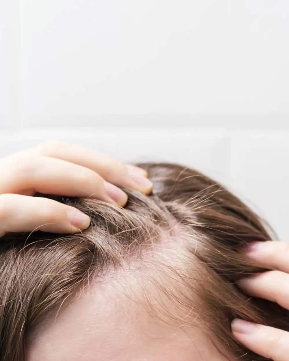 Θεραπεία Τριχόπτωσης & Αλωπεκίας Αγρίνιο | Δρ. Μικρόβα